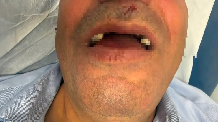 Jerusalem Bus Driver Loses Front Teeth After Vicious Assault By Teens